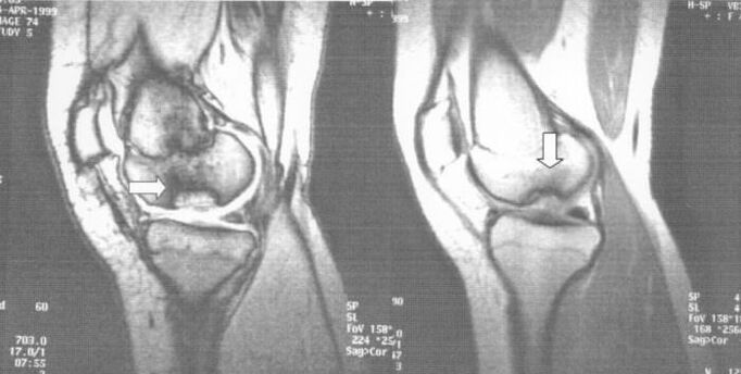 X-ray d'ostéochondrose disséquante dans l'articulation du genou