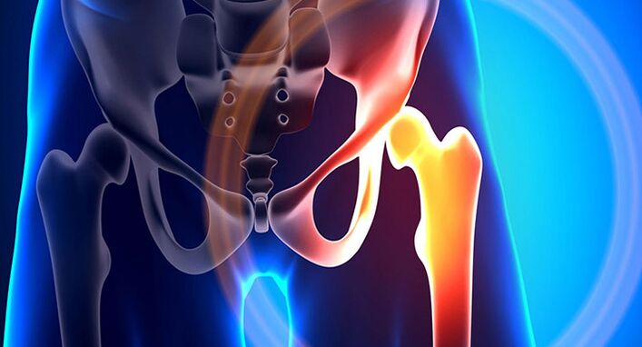 La douleur à la hanche est un symptôme de nombreuses pathologies différentes