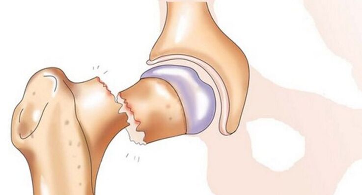 Une fracture du col fémoral s'accompagne de douleurs intenses au niveau de l'articulation de la hanche